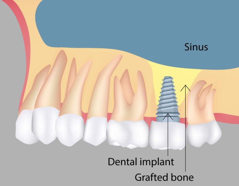 Maxillary Sinus Lift – Medical Art Tourism